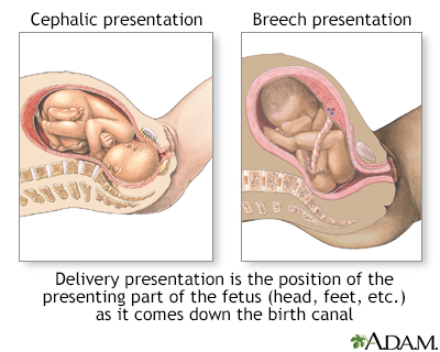 Different types of fetal presentation